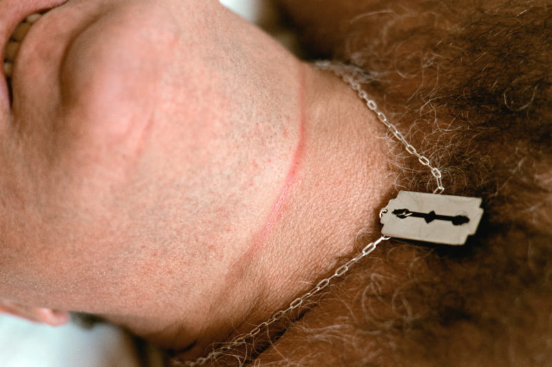 editorial photography at a psychiatric ward: A male patient is in bed. He is wearing a necklace with a piece of jewellery in the shape of a razor blade. On his neck are the traces of a rope with which he tried to kill himself.